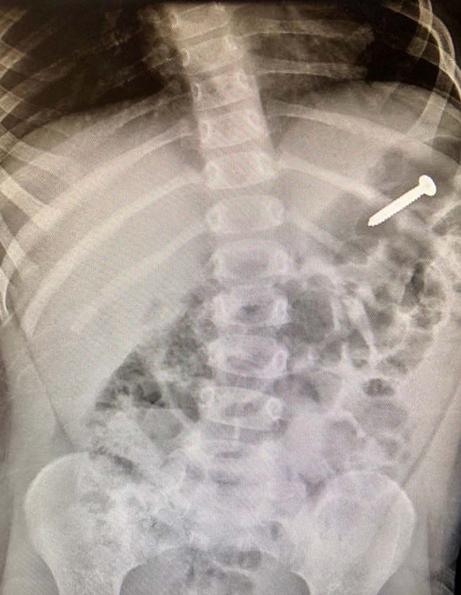 x-ray or imaging scan of retained object